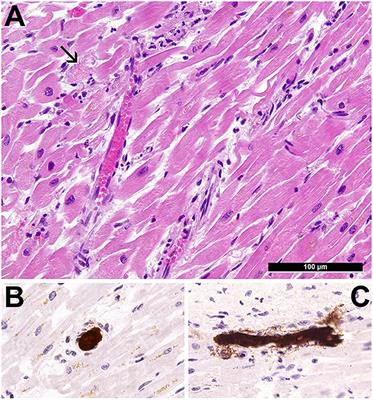 Case Report: Co-occurrence of Myocarditis and Thrombotic Microangiopathy Limited to the Heart in a COVID-19 Patient